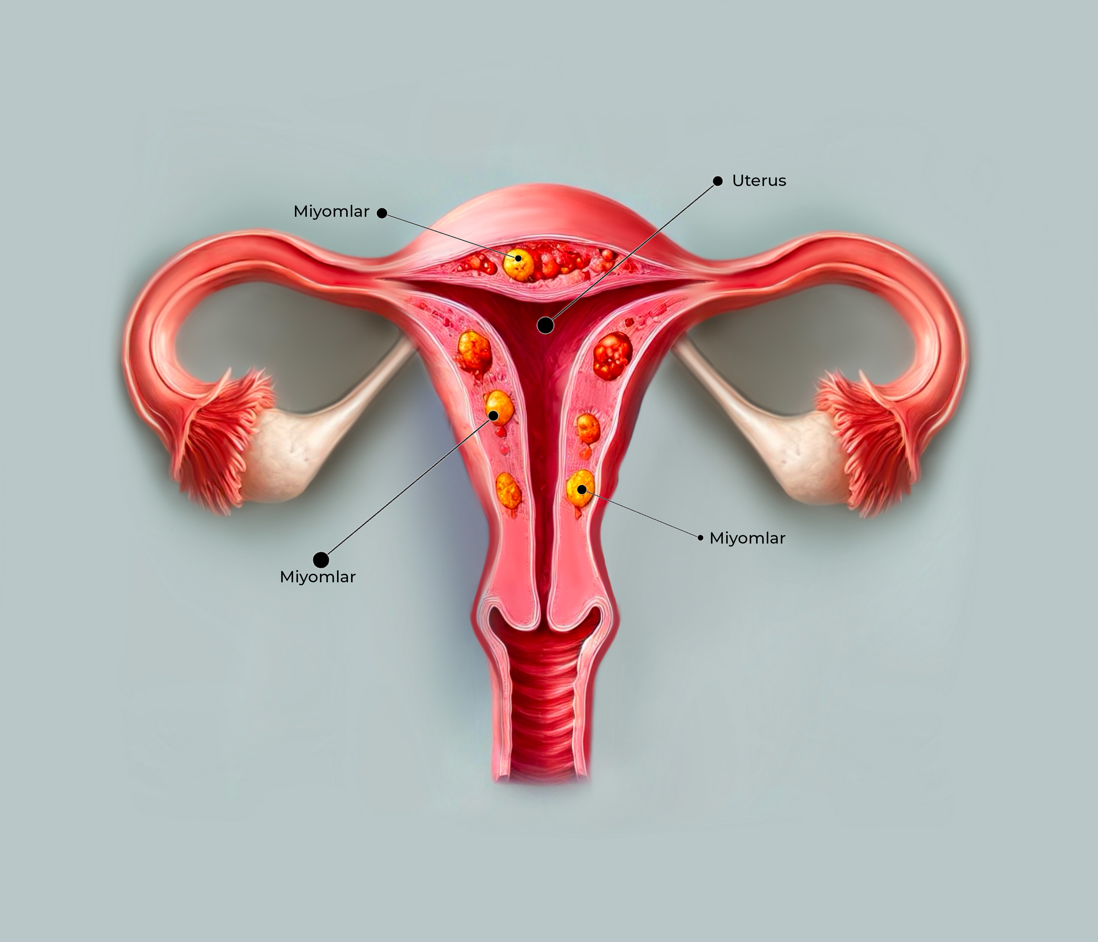 Miyomlar (Uterin Fibroidler)