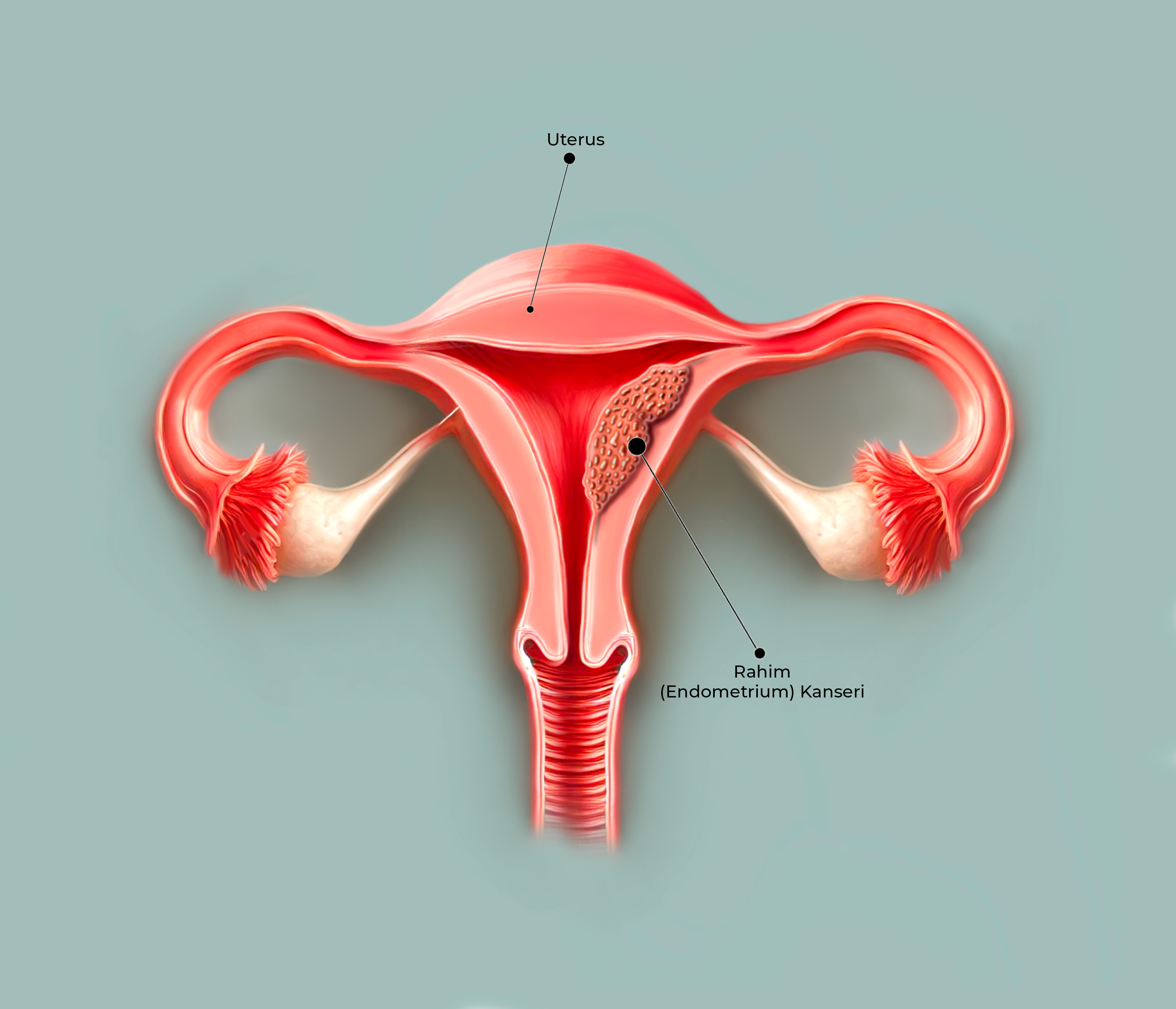 Rahim (Endometrium) Kanseri