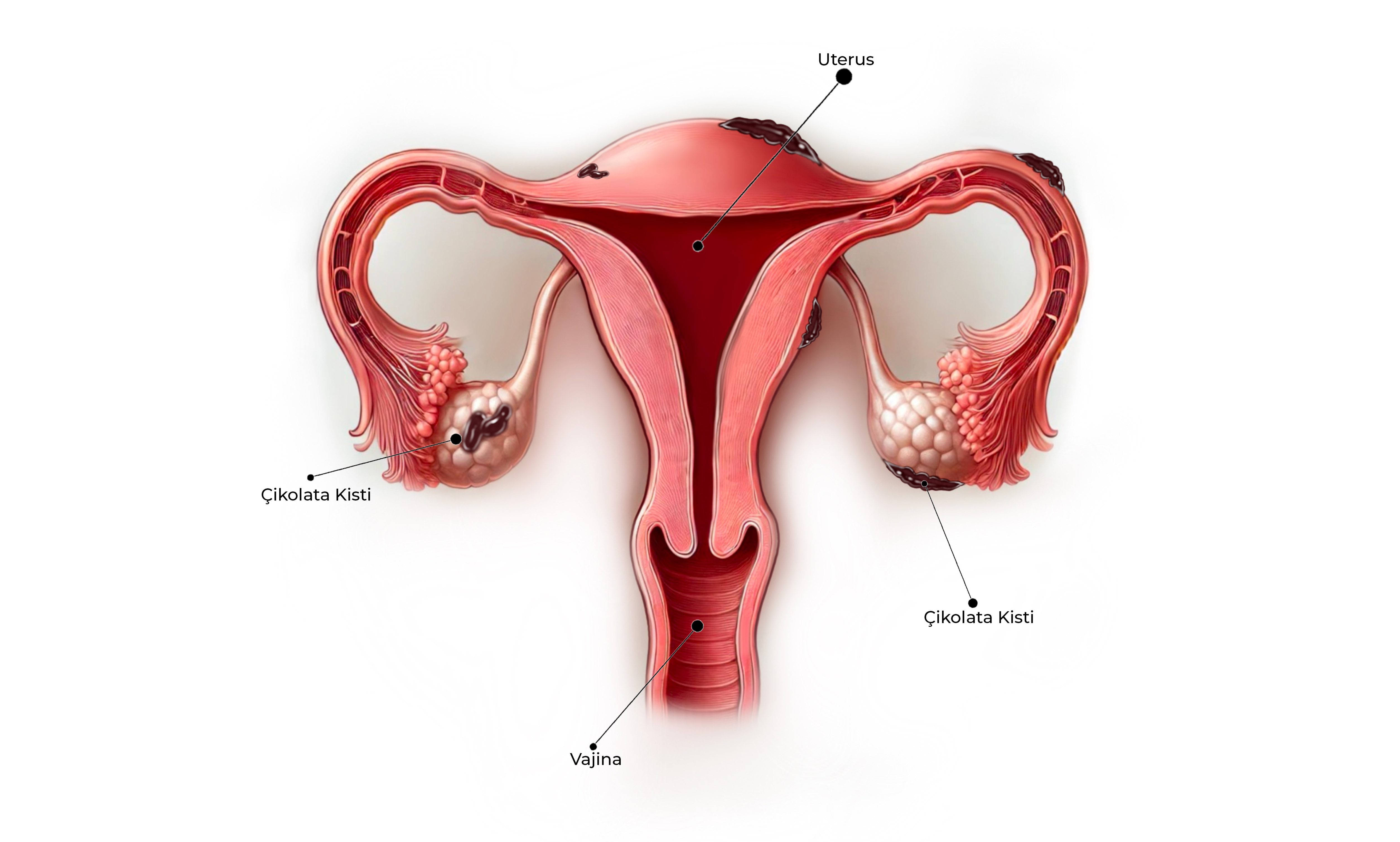 Çikolata Kisti Görseli