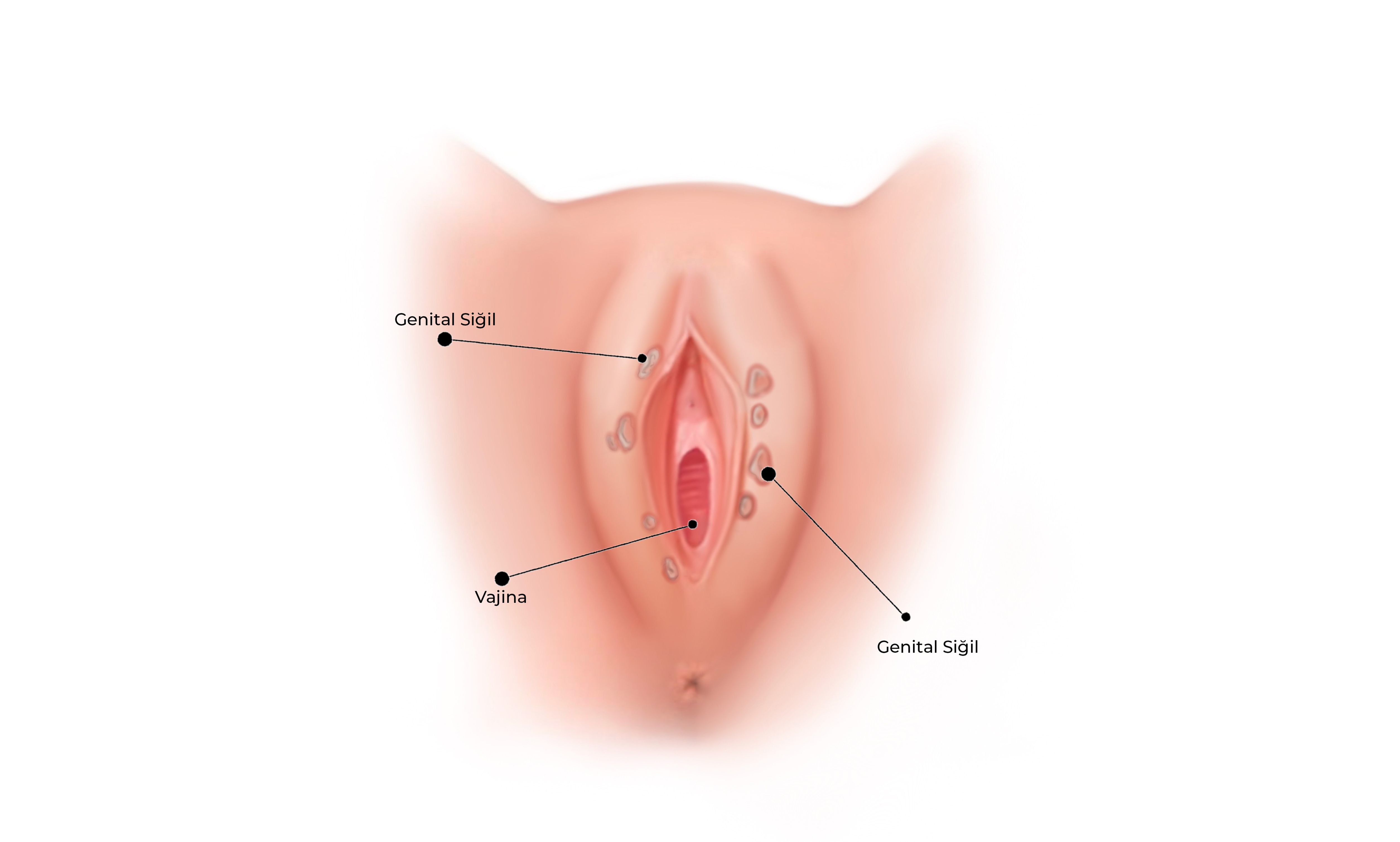 Genital Siğiller Görseli