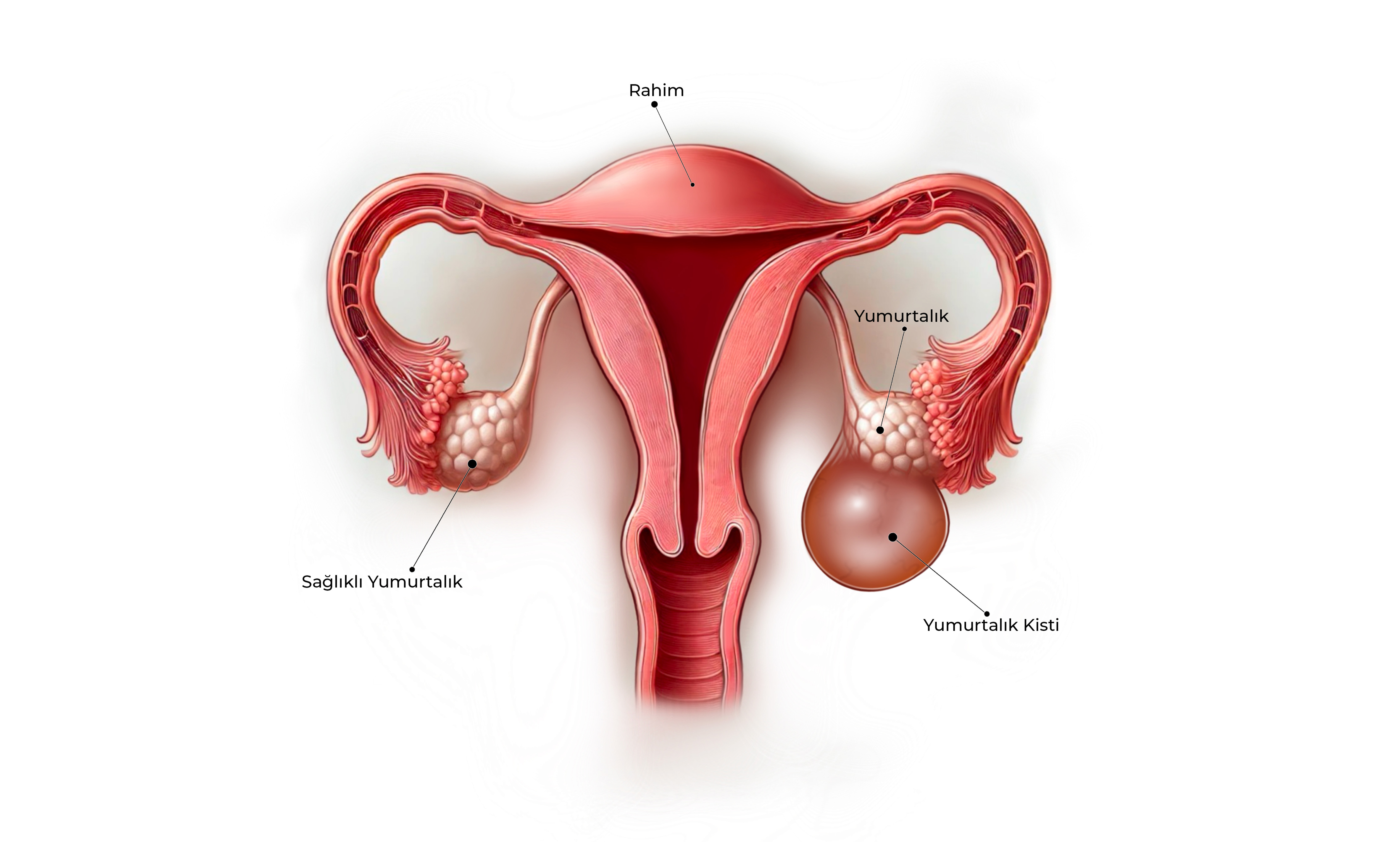 Yumurtalık Kisti Görseli